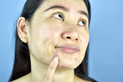 TOP 10 MYTHS ABOUT ACNE