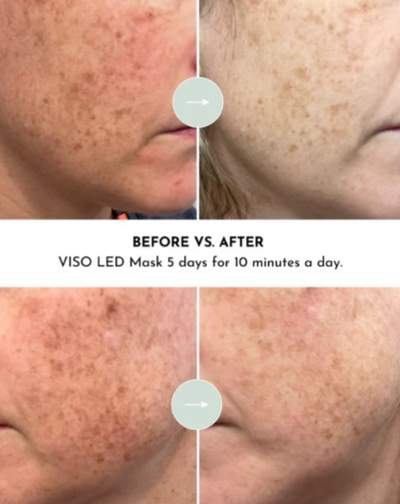 LED Mask Viso by Lumara